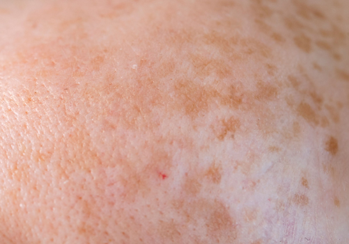 Manchas & Melasma
