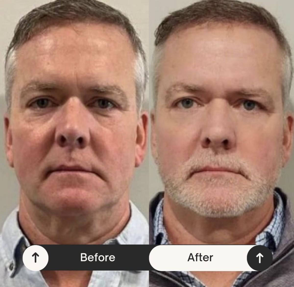 Rejuvenecimiento facial — antes / después