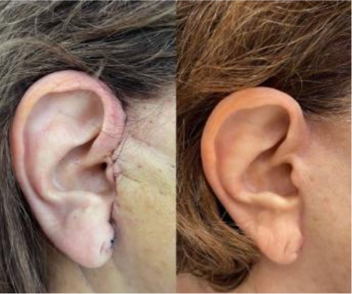 Cicatriz post-quirúrgica en oreja — con puntos / cicatrizada