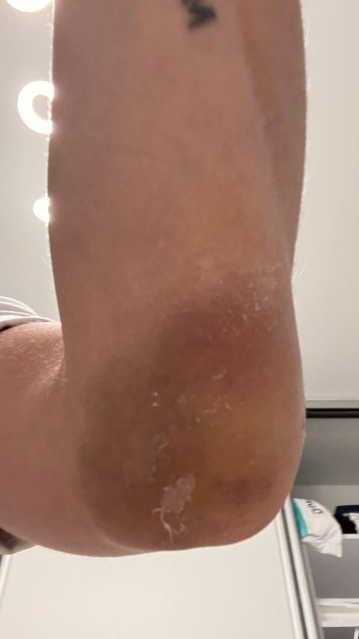 Bursitis y fisura de codo — hematoma antes del tratamiento