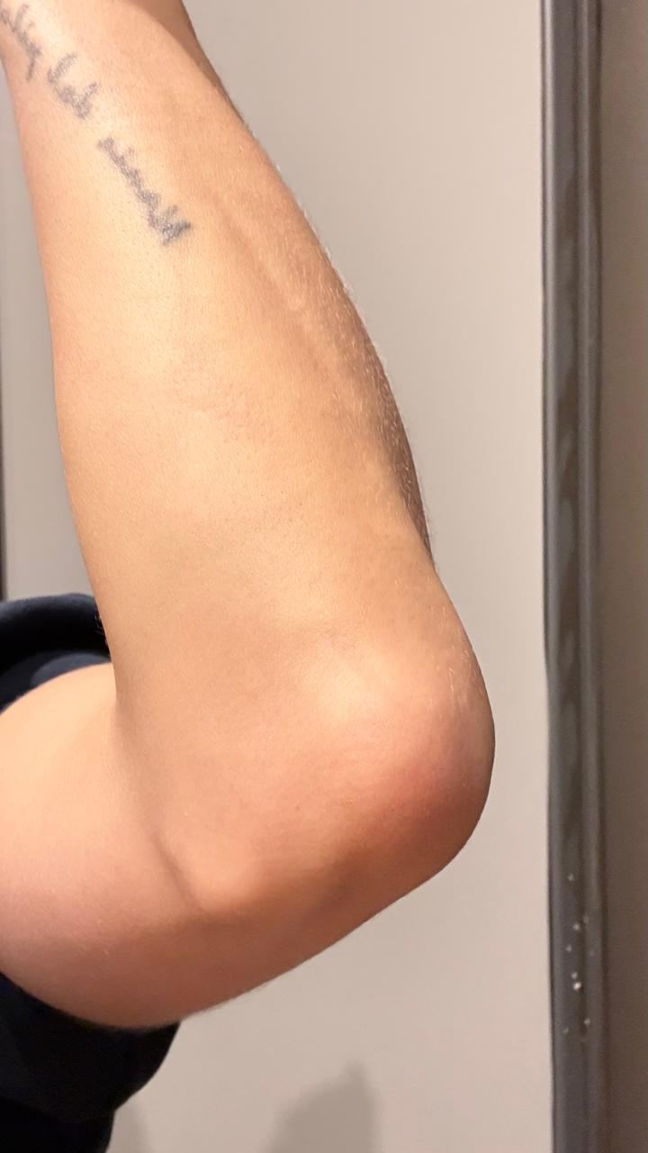 Bursitis y fisura de codo — piel recuperada