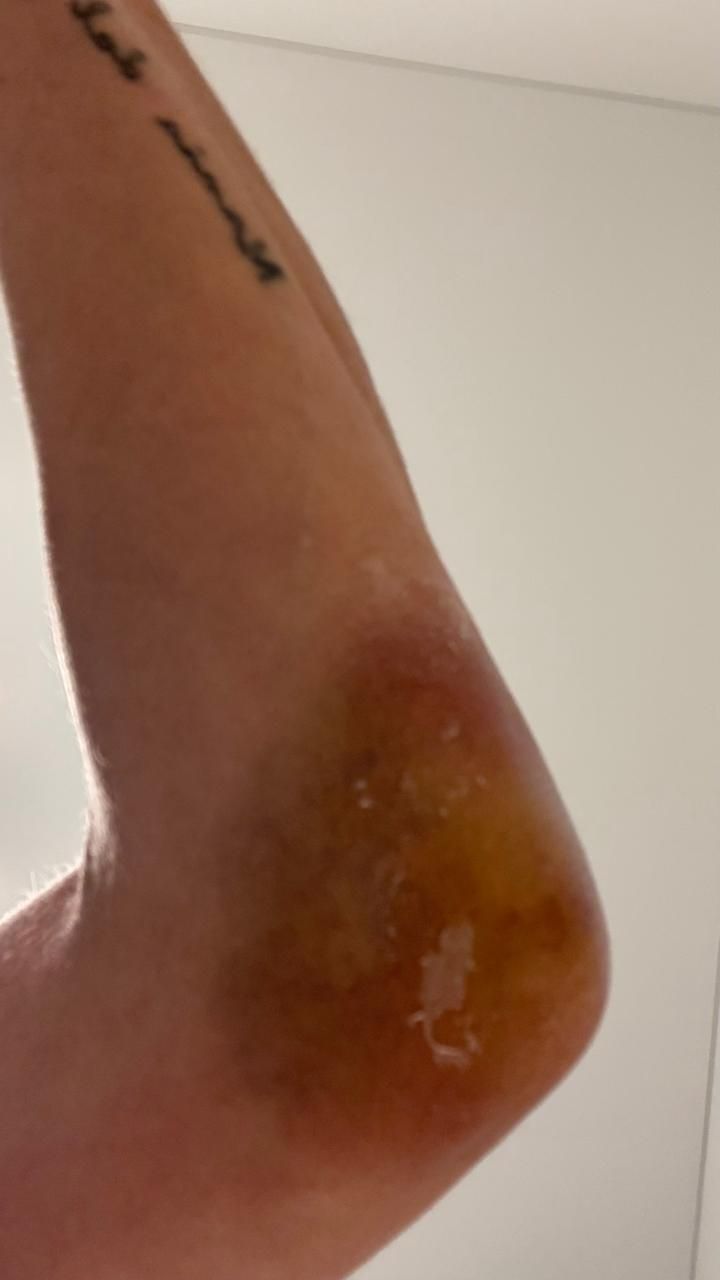 Bursitis y fisura de codo — otro ángulo, mismo caso