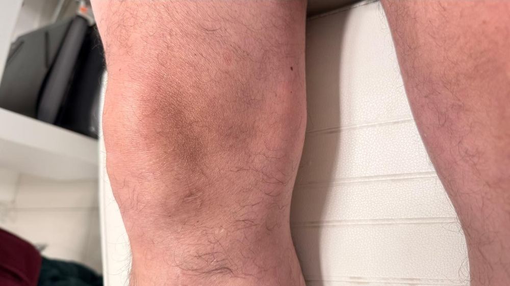 Inflamación post-quirúrgica de ligamentos cruzados y meniscos — inflamación y hematoma