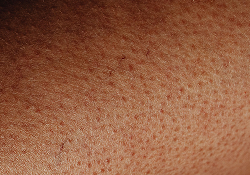 Mesoterapia Francesa