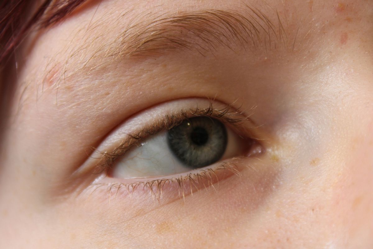 Ojeras vasculares